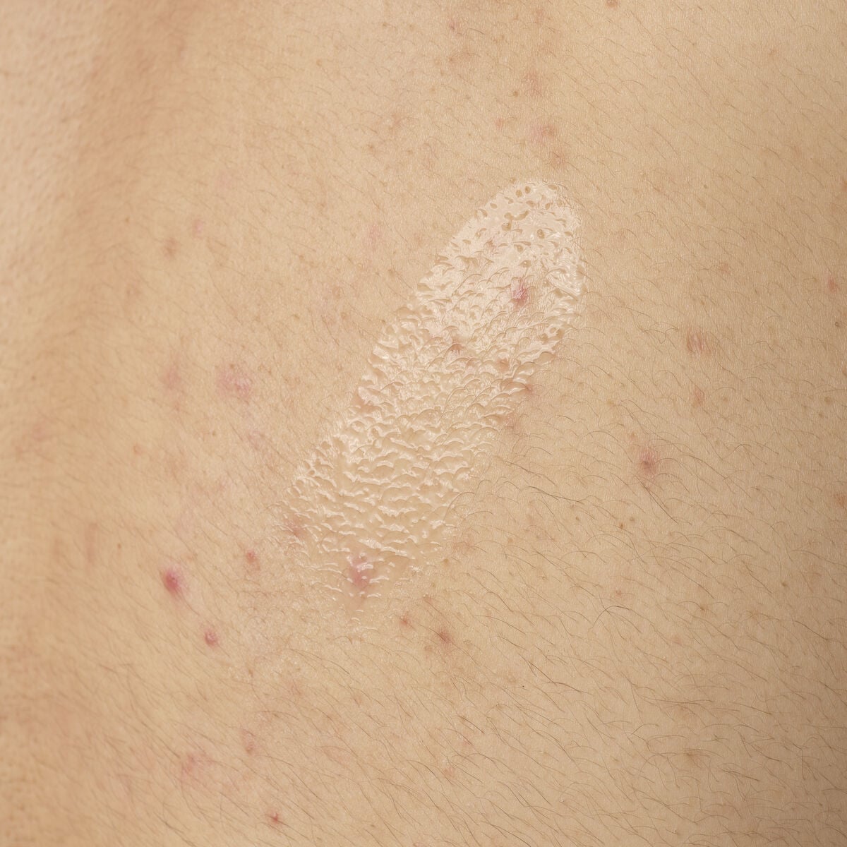 salicylic-acid-0-5-body-serum-l3 ORD-salicylic-acid-05-body-240ml-application.jpg