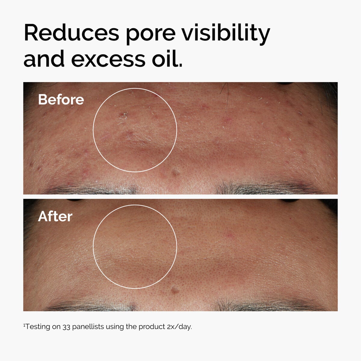 niacinamide-10-zinc-1-u2 ord-niacinamide-zinc-blemish-serum-before-after-pores.jpg