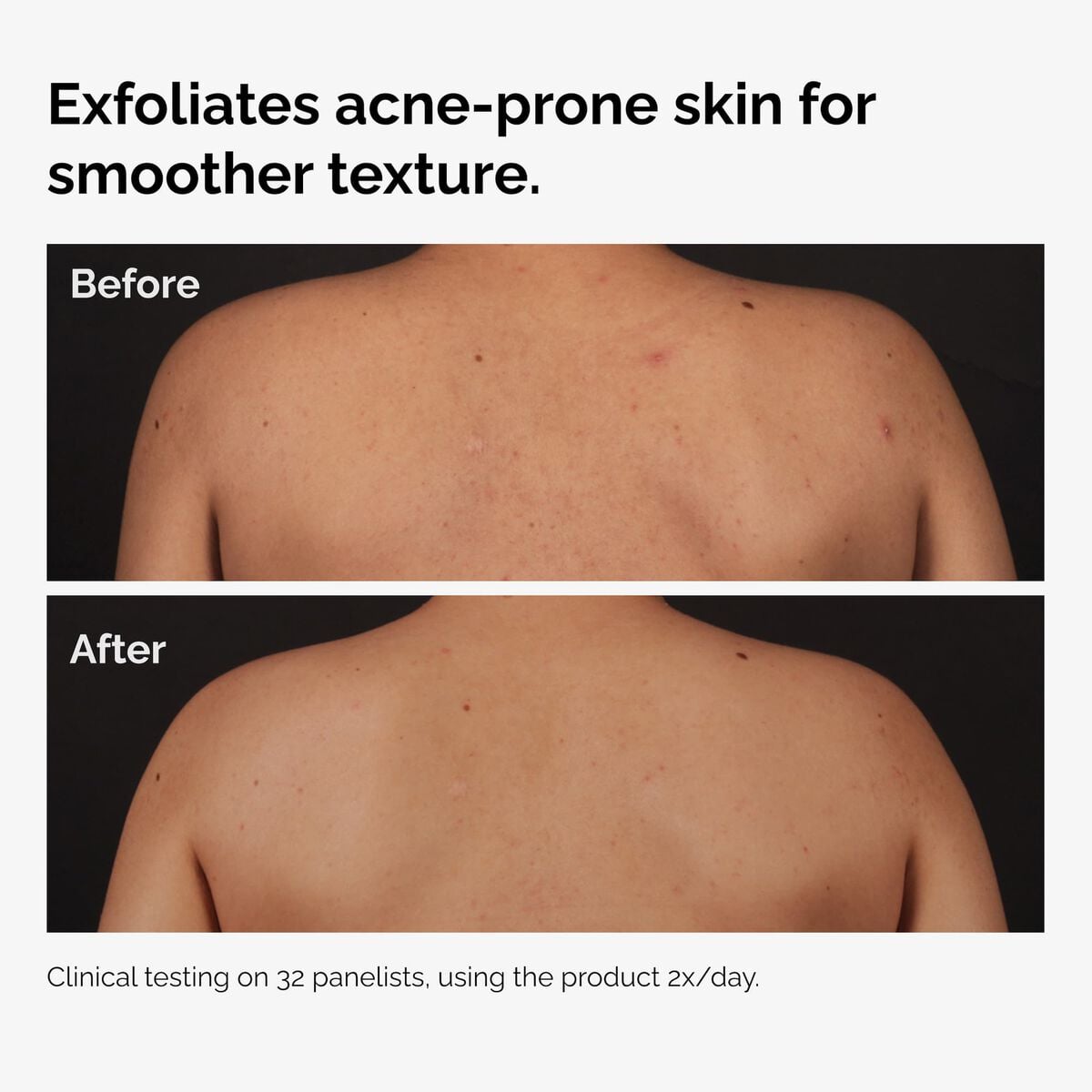 salicylic-acid-0-5-body-serum-l3 ord-salicylic-acid-body-serum-before-after-graphic-NA.jpg