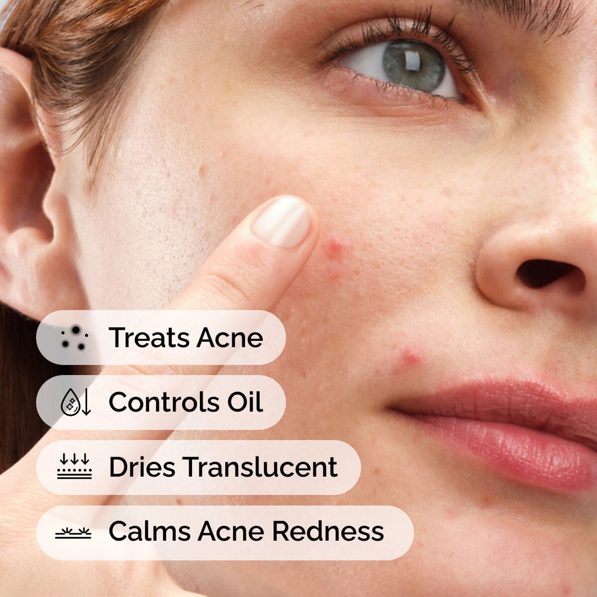 sulfur-10-powder-to-cream-concentrate-z0 ord-sulfur-10pct-powder-to-cream-concentrate-model-application-with-benefits-acne.jpg