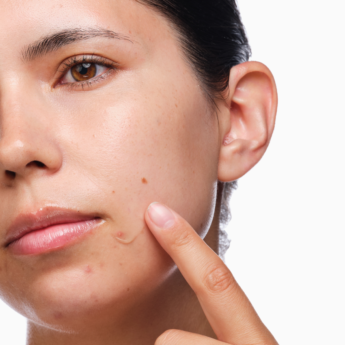 the-acne-set-u0 rdn-the-acne-set-application.png